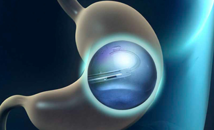 Endoscopia bariatrica